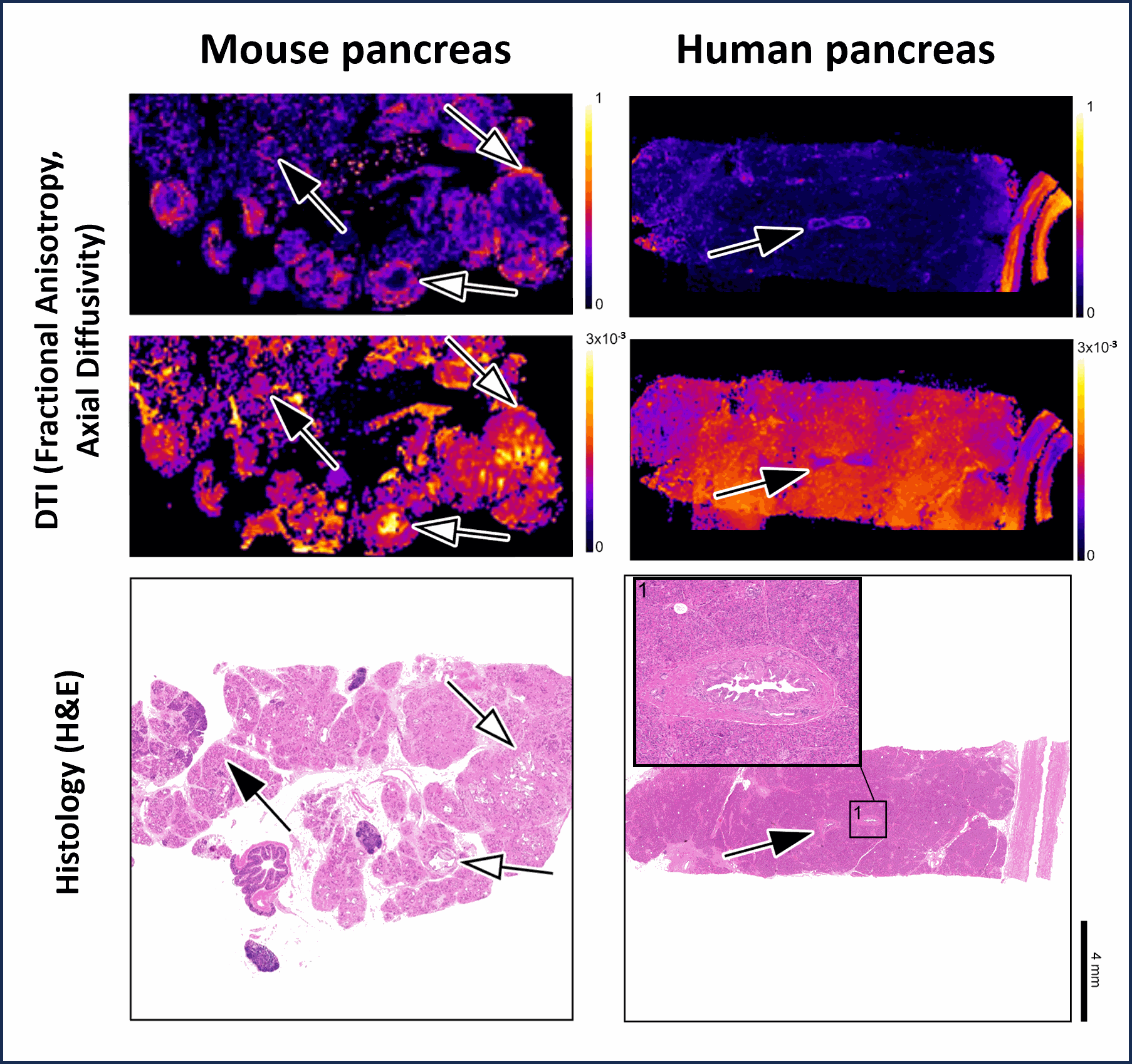 Researchers Detect Pre-Maligant Pancreatic Lesions