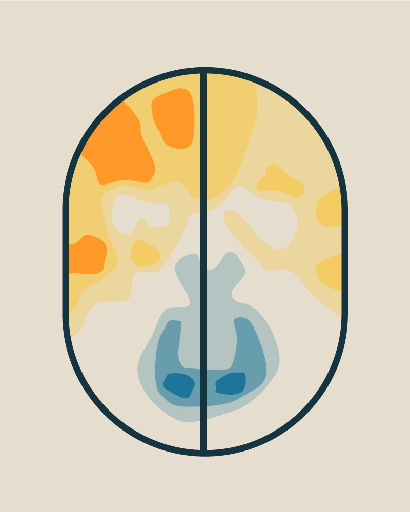 Researchers create a map that highlights the brain circuits associated with mania