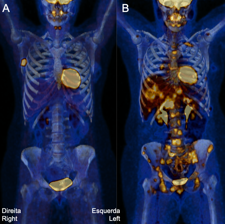 Breast cancer: first scientifically validated guidelines on the usefulness of the imaging exam known as FDG PET/CT