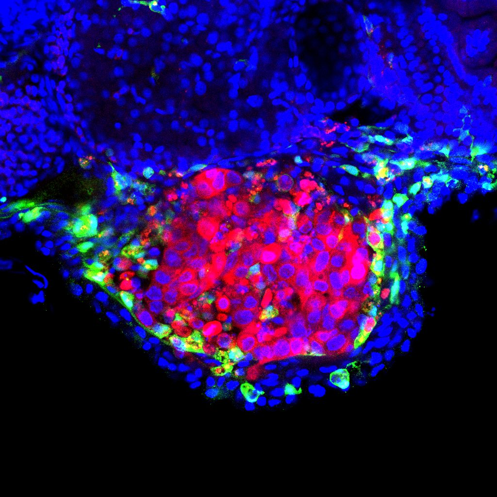 A human bladder tumour (red) surrounded by zebrafish macrophages (green)