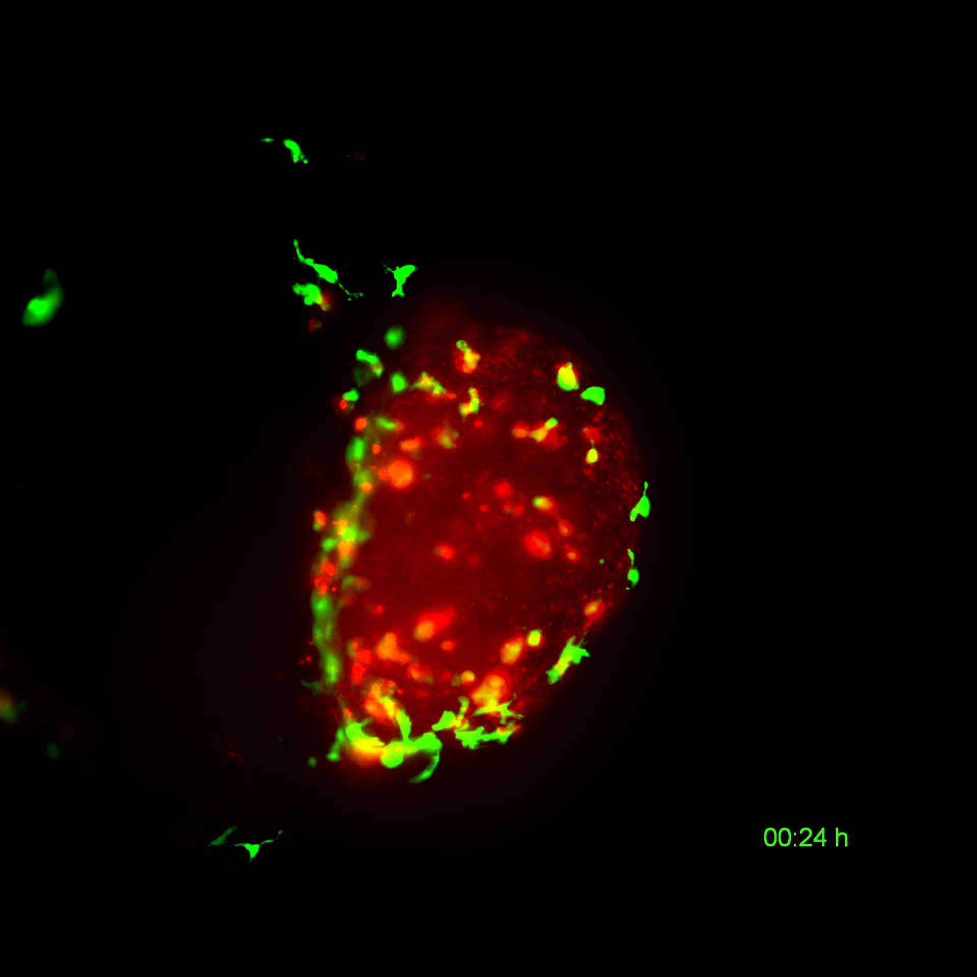 Still image from a 21-hour video showing a human bladder tumour (red) being cleared by zebrafish macrophages (green)