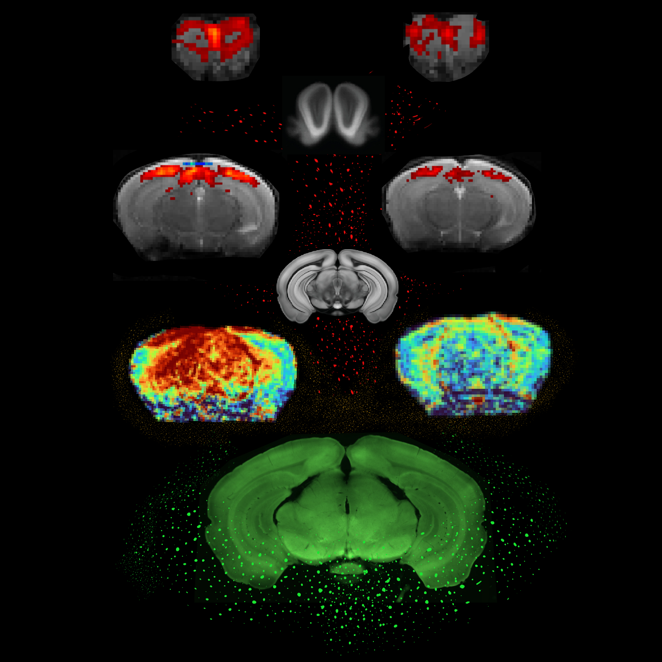 A esperança de detectar a doença de Parkinson muito mais cedo com um simples scan cerebral