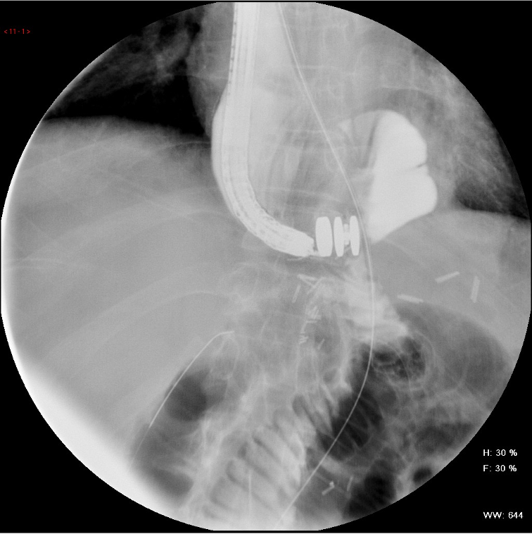 X-ray of MAGUS inserted in the digestive tract