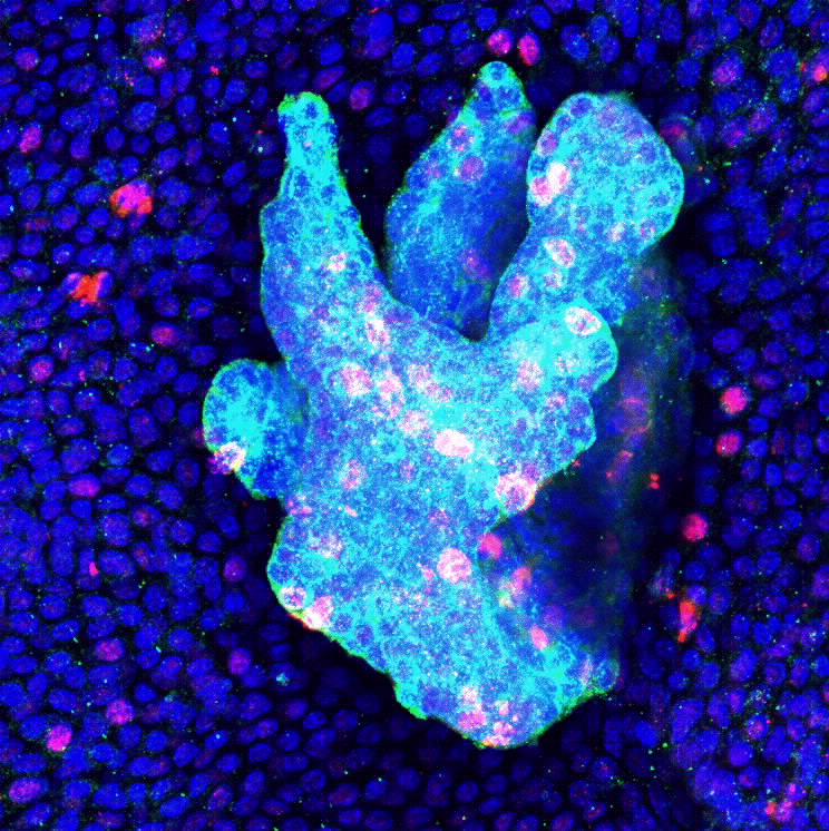 Investigadores descobrem mecanismos de iniciação e progressão do cancro da pele mais comum nos seres humanos