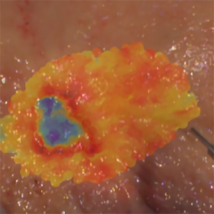 “Pintar” os tecidos com luz para detectar os tumores cancerosos e as suas margens