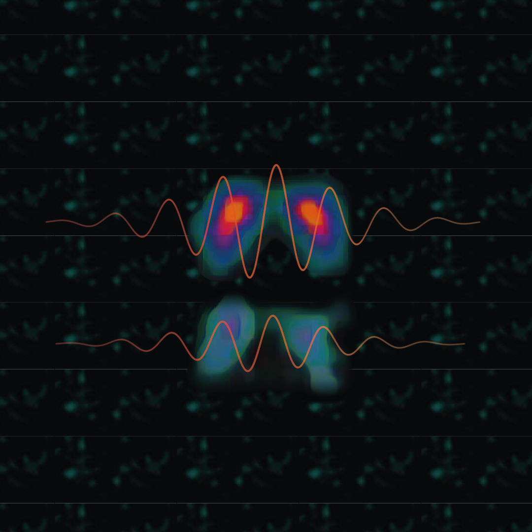 Parkinson’s Paradox: When More Dopamine Means More Tremor